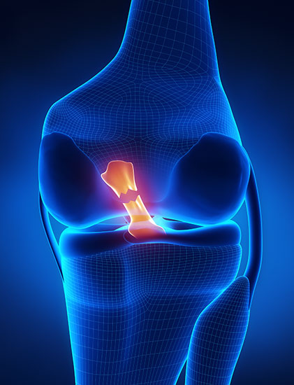 acl tear illustration