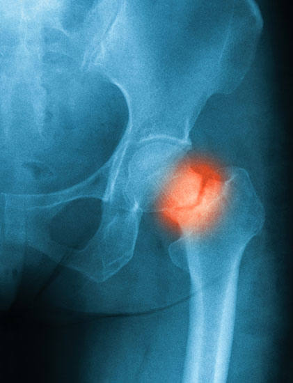 hip fracture x-ray