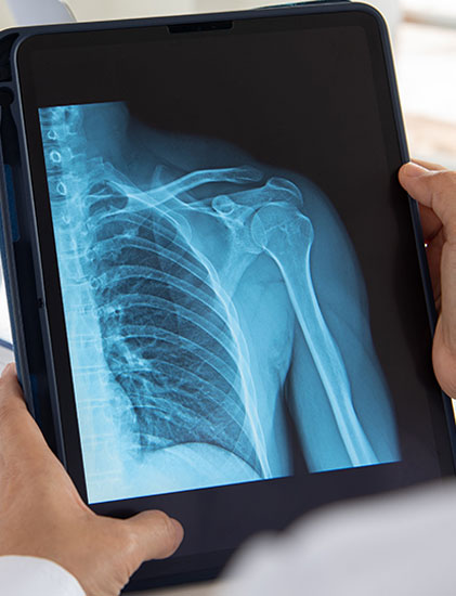 Shoulder X-Ray