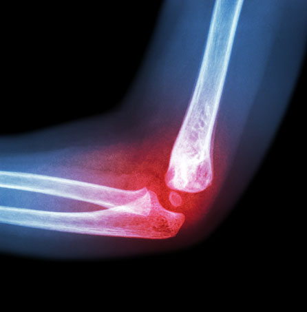 elbow x-ray