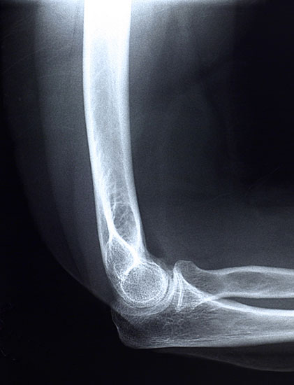 elbow x-ray