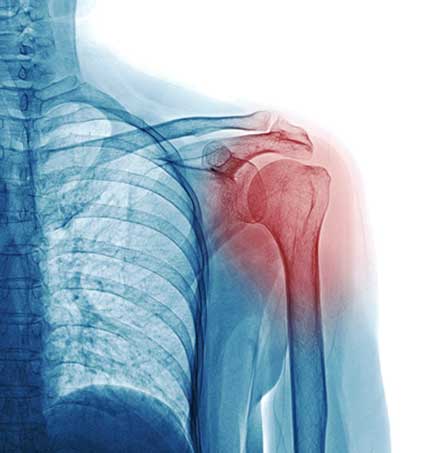 shoulder x ray